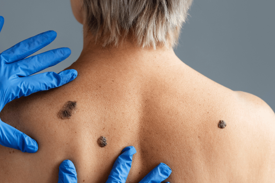 Como prevenir o câncer de pele: guia do dermatologista